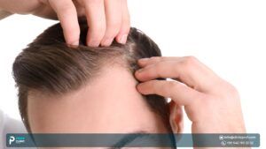 hair transplant in Istanbul reviews - Prof Clinic