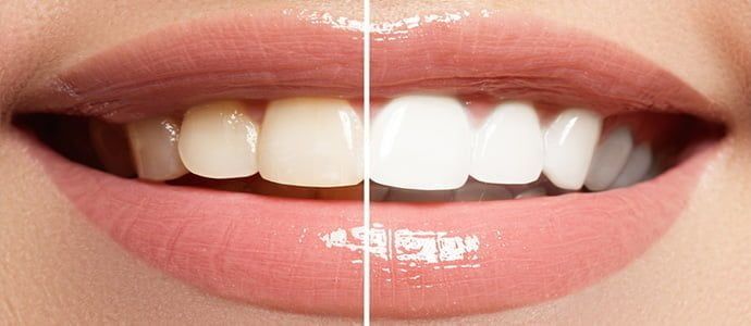 the Best Smile Makeover: Transform Your Confidence