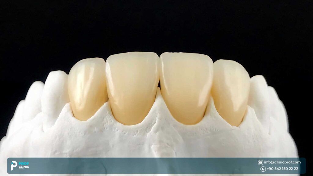 types of zirconia crowns in Turkey - Prof Clinic Istanbul