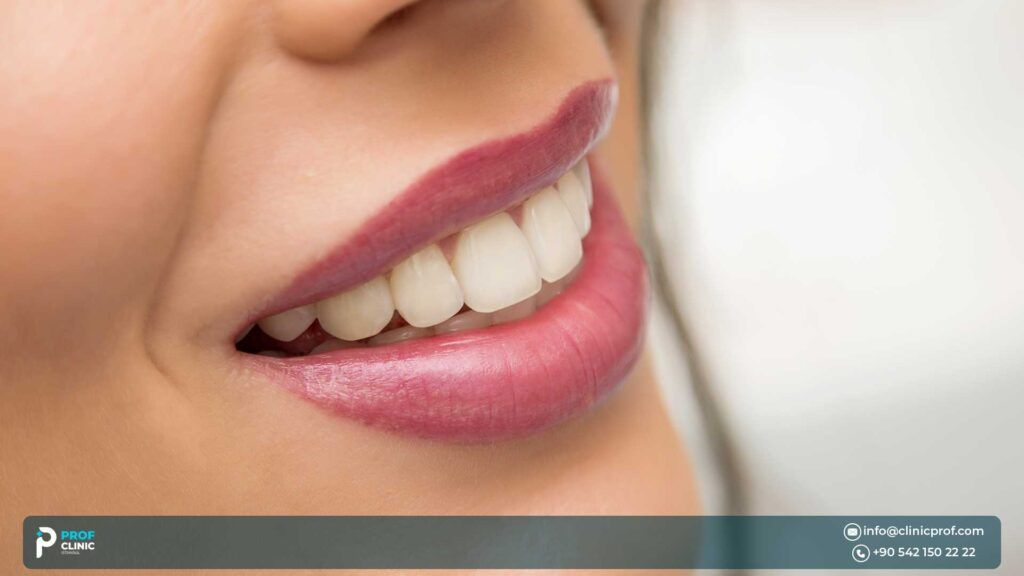veneers in Turkey Istanbul - Prof Clinic Istanbul - best Clinic in Turkey