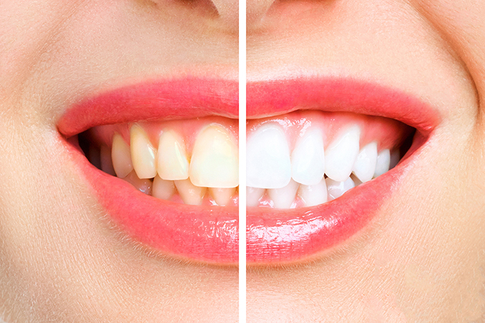Yellow Teeth VS White Teeth - الأسنان الصفراء والبيضاء