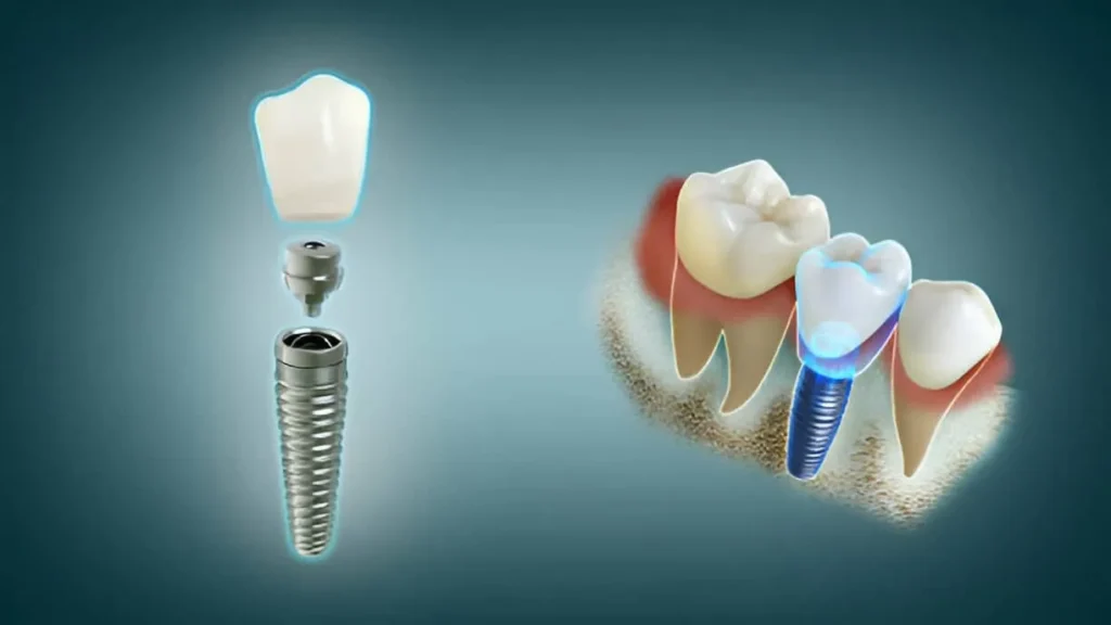 Best Dental Implants in Istanbul Turkey