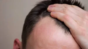 أسباب تساقط الشعر والصلع عند الرجال