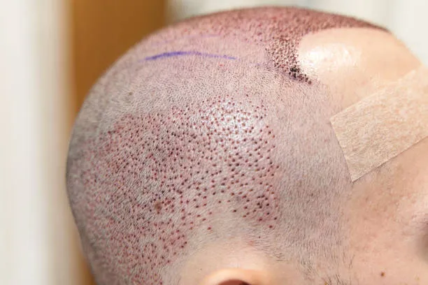 أسعار زراعة الشعر حسب نوع العملية