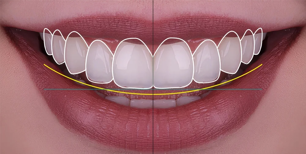 أفضل أنواع وأشكال ابتسامة هوليود: كيف تختار الأفضل؟