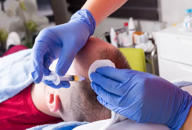 أفضل تقنيات زراعة الشعر للرجال