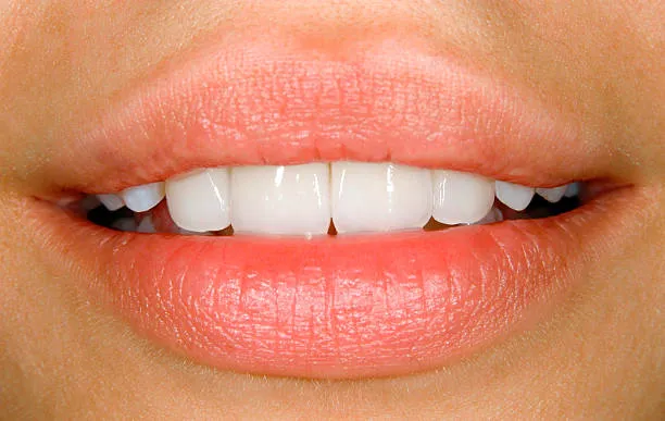 أنواع الفينير للأسنان