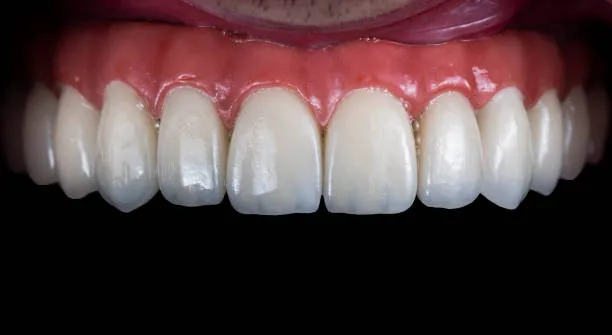 أنواع عدسات الأسنان وأفضلها مع الأسعار