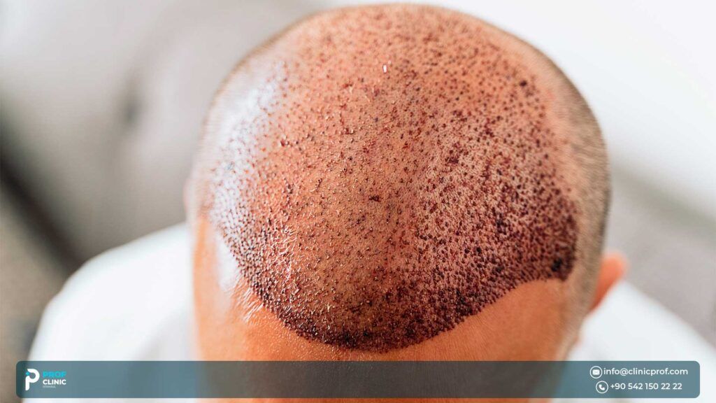 العوامل المؤثرة في تكلفة زراعة الشعر في تركيا