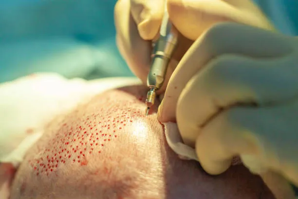 العوامل المؤثرة في تكلفة زراعة الشعر في تركيا