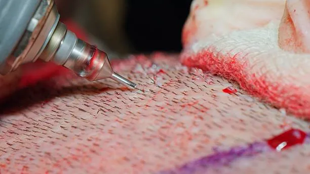 الفرق بين زراعة الشعر الطبيعي والصناعي