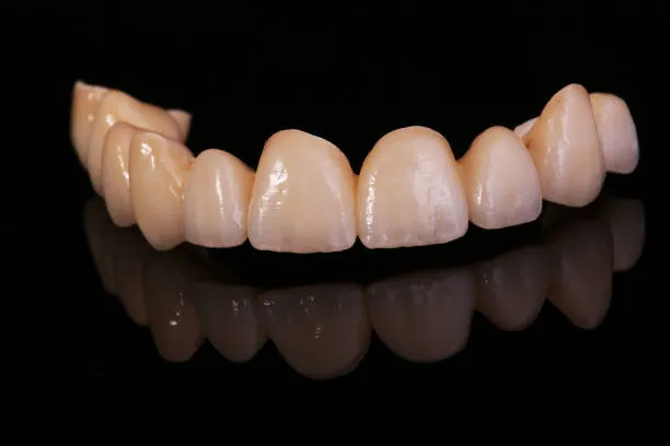 الفينير المتحرك