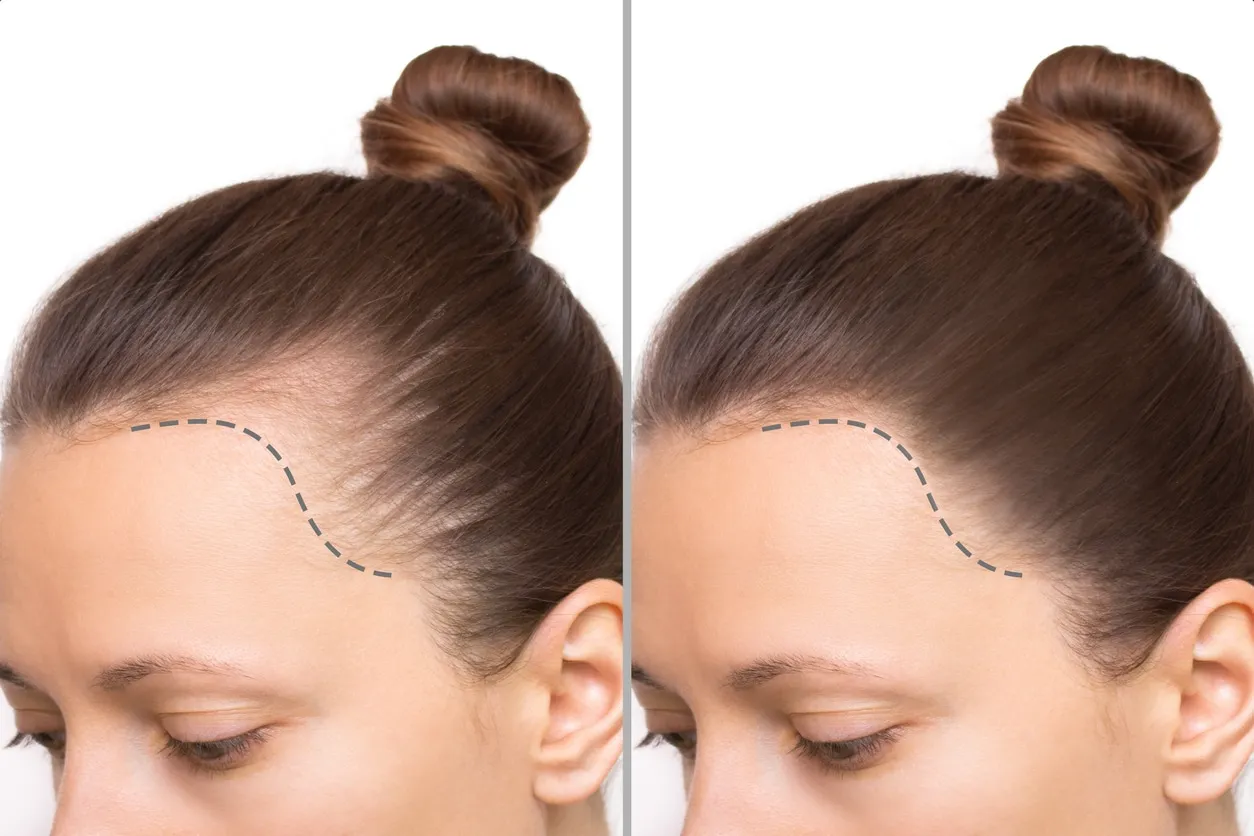 Female Hair Transplant: Causes, Techniques & Cost Explained