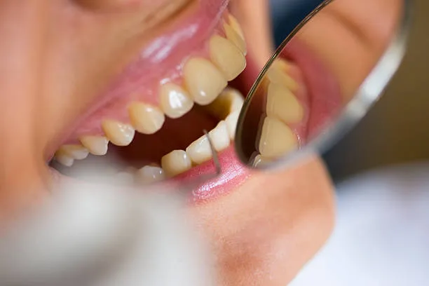 تركيبات الزيركون وأسنان الزيركون