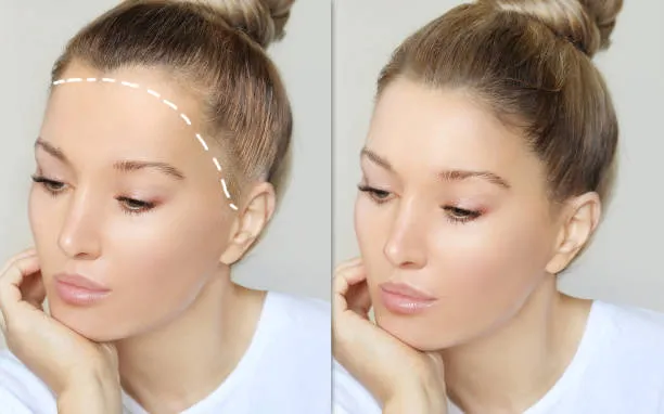 تكلفة زراعة خط الشعر مقارنة بزراعة الشعر الكامل في تركيا