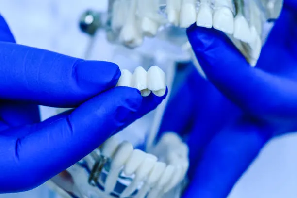 جسر الأسنان