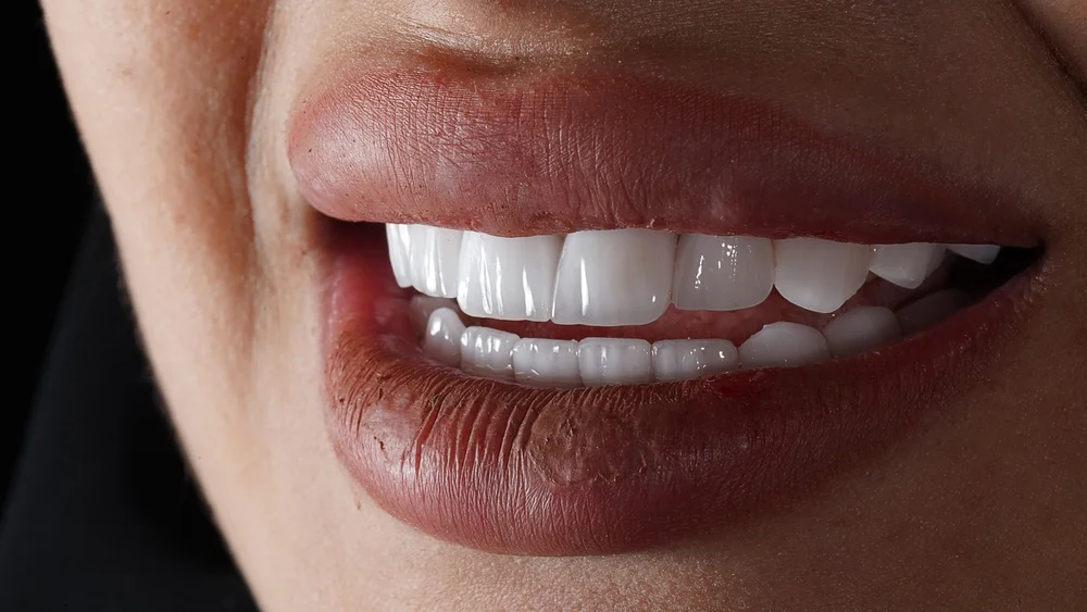 جميع أضرار وفوائد ابتسامة هوليود (هوليوود سمايل)