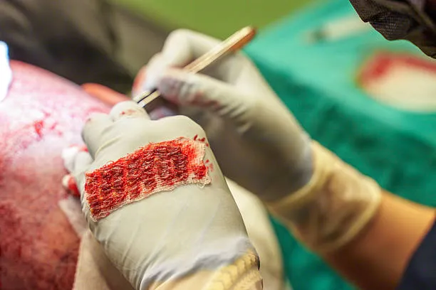 خطوات إجراء زراعة الشعر بتقنية FUT