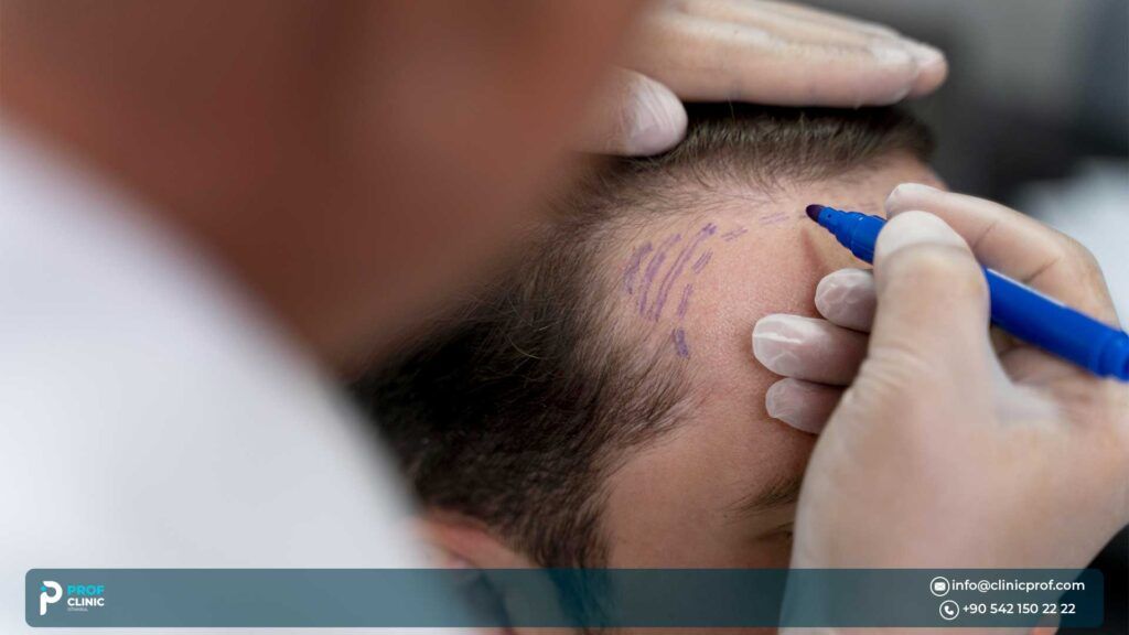 خطوات زراعة الشعر