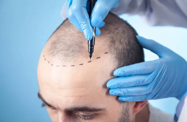 خطوات زراعة الشعر للرجال
