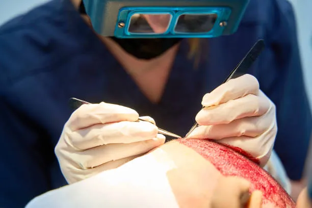 خطوات زراعة الشعر