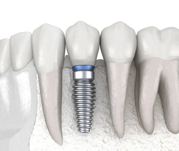 نظرة معمّقة على زراعة الأسنان