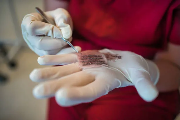 زراعة الشعر الطبيعي