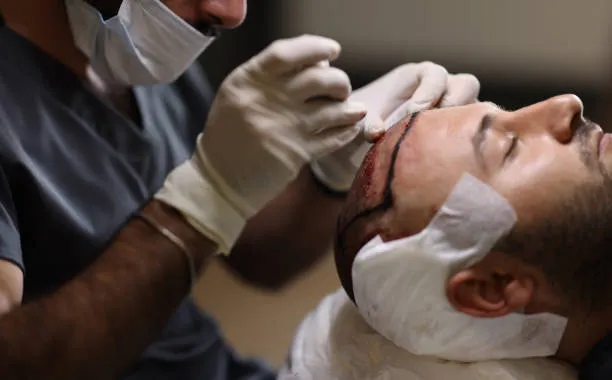 زراعة الشعر المميزات والعيوب والتكاليف وكل ما تود معرفته