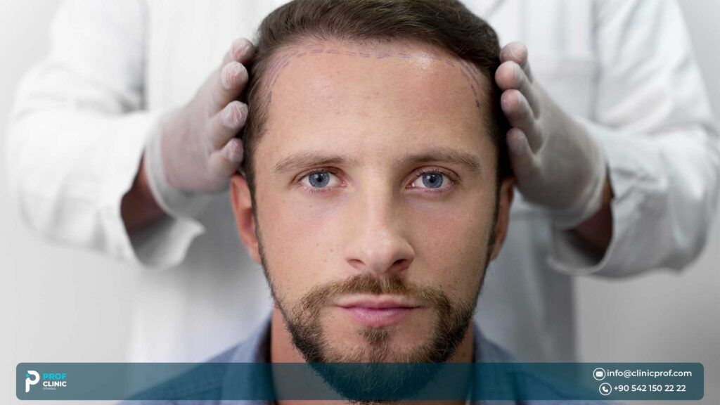 زراعة الشعر بتقنية FUE في تركيا: قبل وبعد