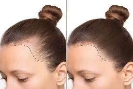 عيادة بروف لأفضل خدمة زراعة شعر للنساء في تركيا