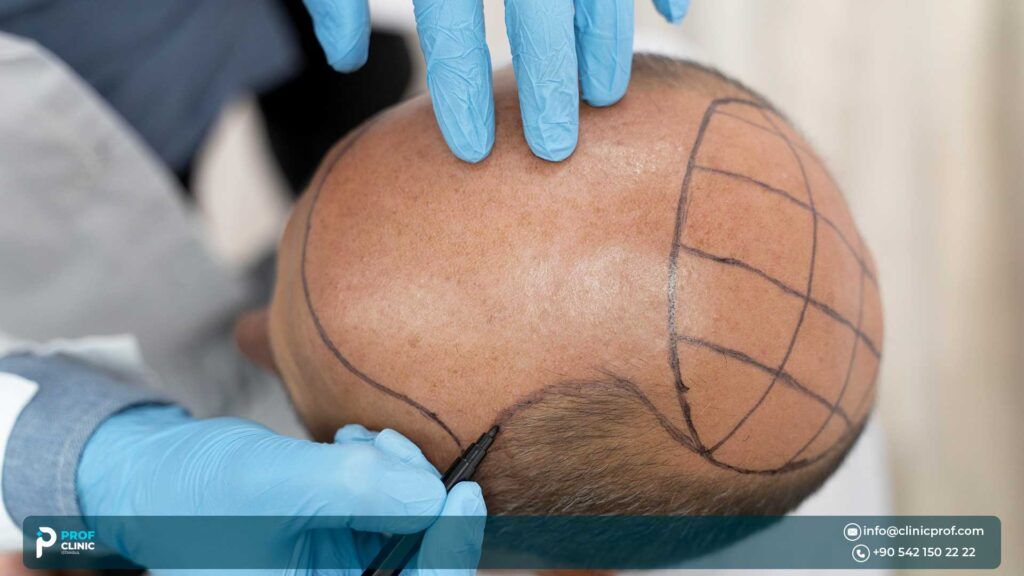 فوائد وعيوب زراعة الشعر بتقنية FUE