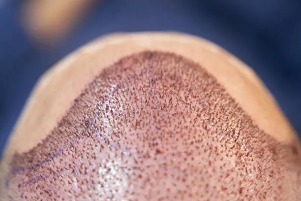 فوائد وعيوب زراعة الشعر بتقنية FUT