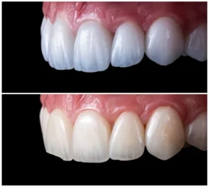 فينير السيراميك قبل وبعد