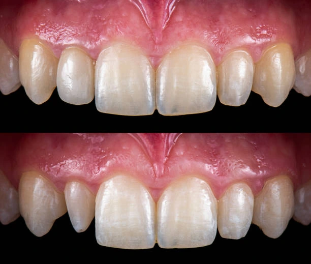 قشور البورسلين قبل وبعد