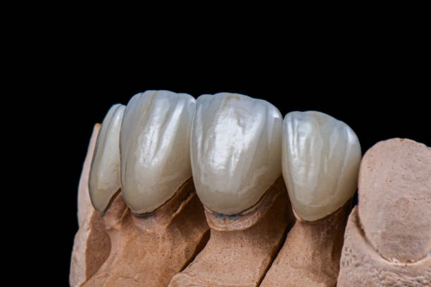 ما هو فينير البورسلين؟