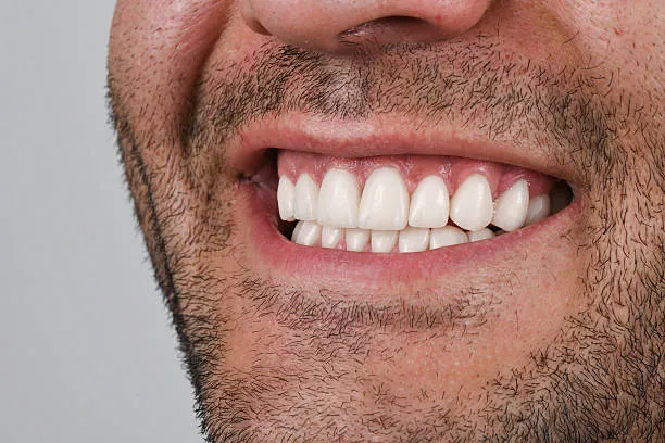 ما هي تركيبات الايماكس للأسنان؟