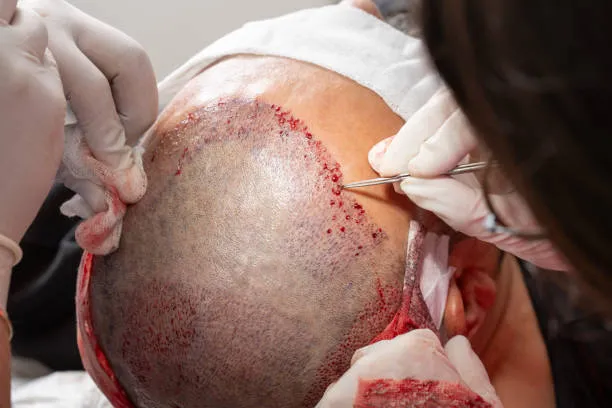 ما هي زراعة الشعر؟