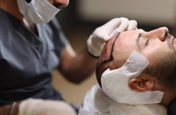 ما هي زراعة الوحدات الجريبية (FUT)؟