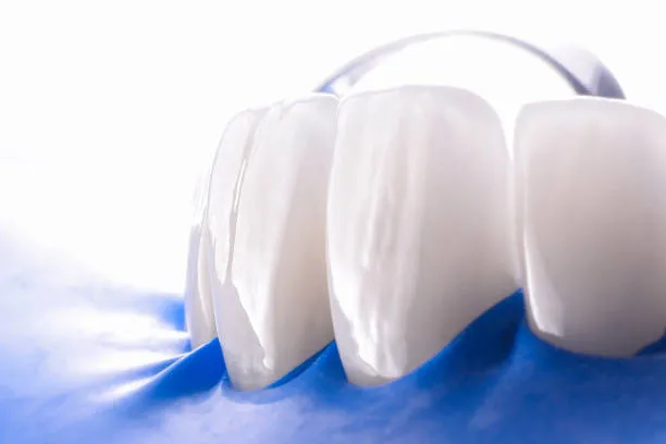 ما هي عدسات الأسنان اللومينير؟