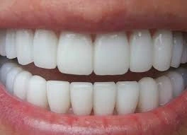 ما هي قشور الفيلدسباثيك؟