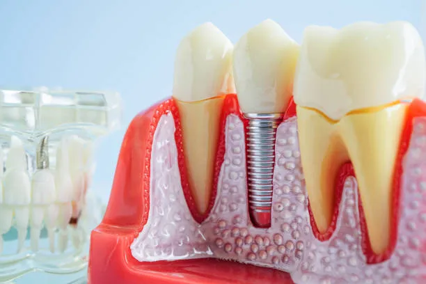 معلومات حول زراعة الأسنان