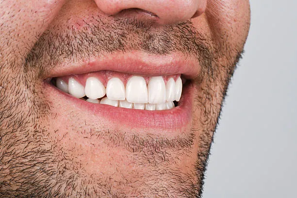 مميزات وعيوب الفينير و ابتسامة هوليود