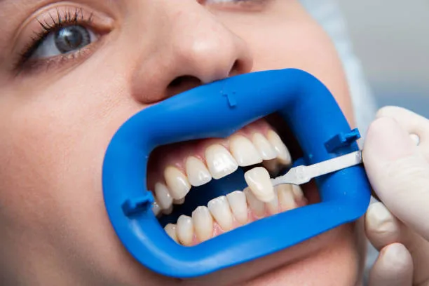 مميزات وعيوب دايركت فينير لابتسامة هوليود