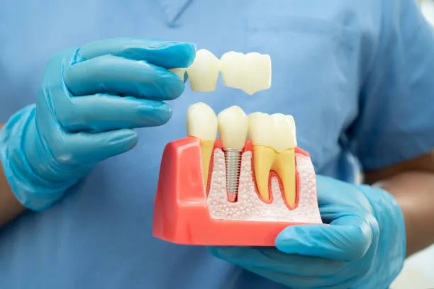 مميزات وعيوب جسور الأسنان و زراعة الأسنان