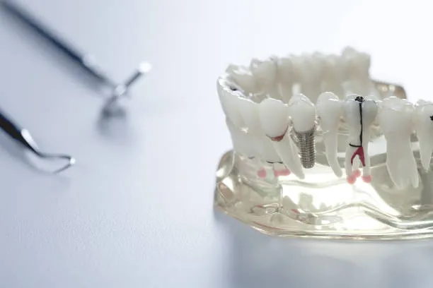 من يمكنه إجراء زراعة الأسنان الفورية؟