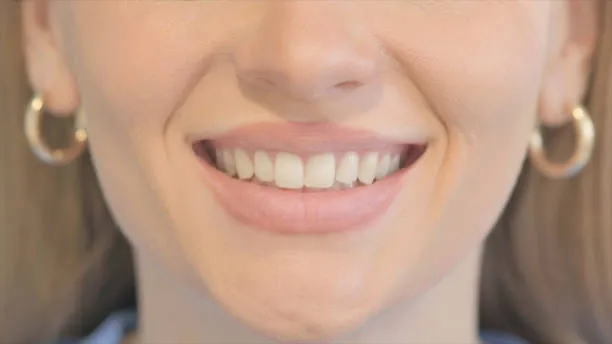 هل يمكنك الحصول على ابتسامة المشاهير؟