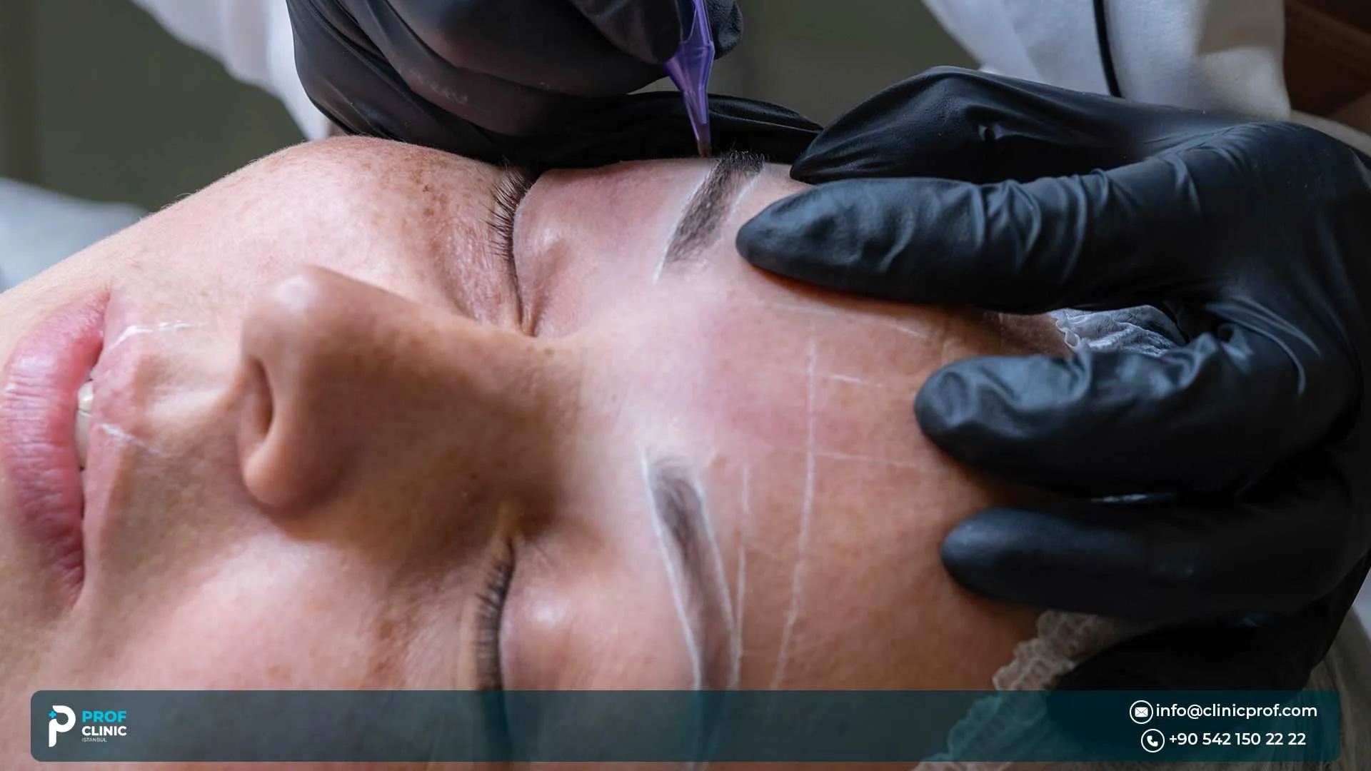 Eyebrow Transplant vs Alternatives: Microblading, PRP, Tattooing & Celebrity Choices