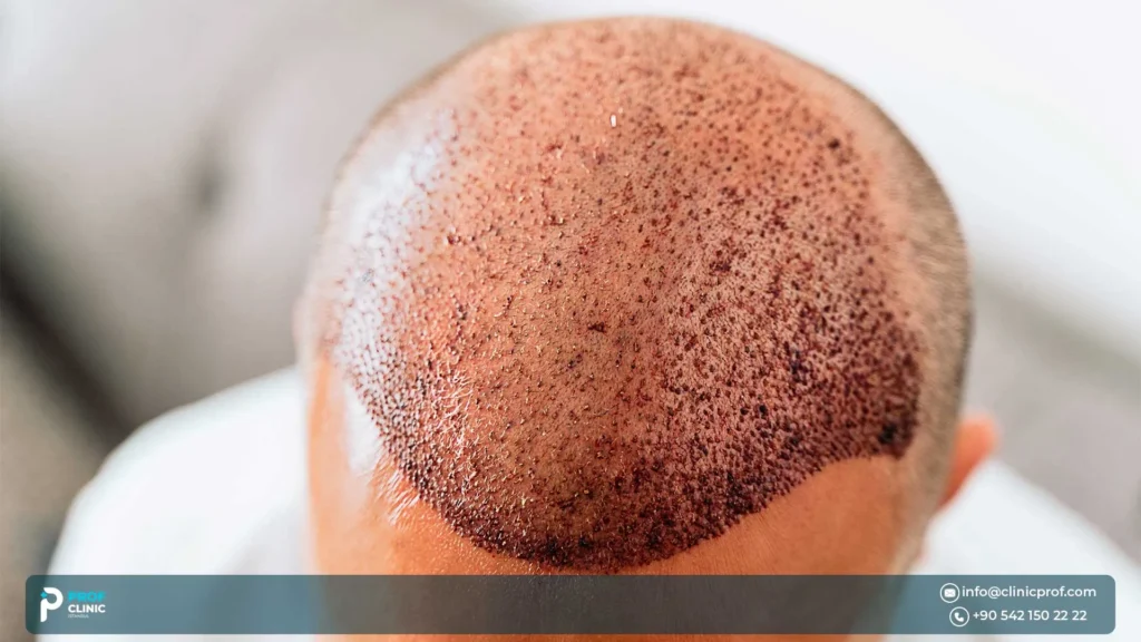 What Happens During an Afro Hair Transplant Procedure