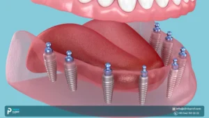 All-on-8 Implants: Maximum Support Option