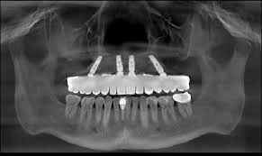 Upper Jaw All-on-4: Special Considerations